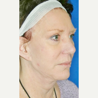 55-64 year old woman treated with Neck Lift after 3055626