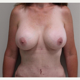 45-54 year old woman treated with Breast Augmentation after 3059899