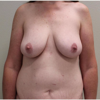 45-54 year old woman treated with Breast Augmentation before 3059899