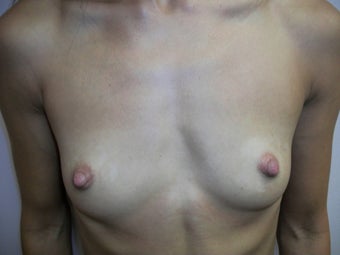 Breast Augmentation before 386385