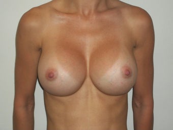 Breast Augmentation after 386385