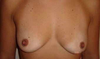 30 y.o. woman, caucasian, weight 52 kg, 1,68 height, with 1 cup size breasts, requesting 1 cup size increase before 750830