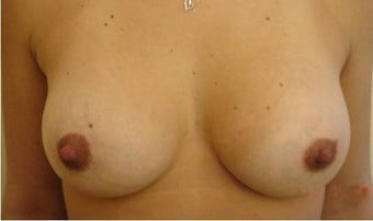 30 y.o. woman, caucasian, weight 52 kg, 1,68 height, with 1 cup size breasts, requesting 1 cup size increase after 750830