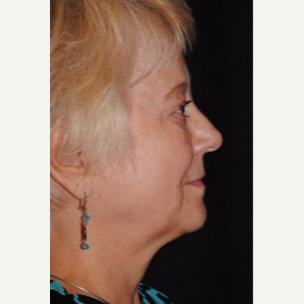 55-64 year old woman treated with Facelift before 3481221