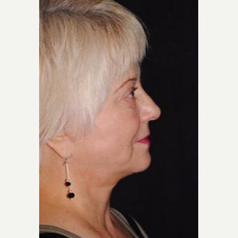 55-64 year old woman treated with Facelift after 3481221