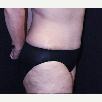 Tummy Tuck and Breast Reduction after 3332897