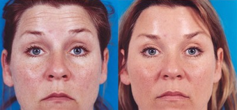 39-year-old woman treated with Botox. after 574299