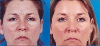 39-year-old woman treated with Botox. before 574299