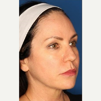 45-54 year old woman treated with Kybella after 3711792