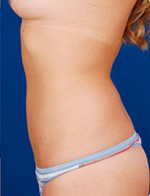 Smart Lipo after 1029377