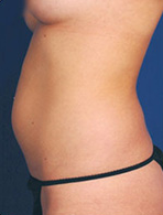 Smart Lipo before 1029377