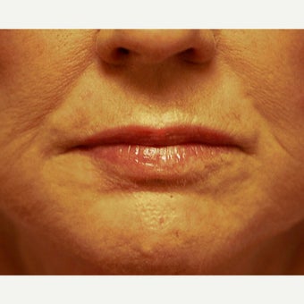 55-64 year old woman treated with Phenol Peel after 1989334