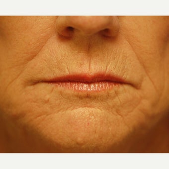 55-64 year old woman treated with Phenol Peel before 1989334
