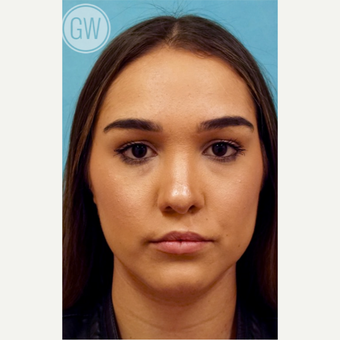 18-24 year old woman treated with Revision Rhinoplasty - Cleft nose with upper lip fat grafting after 3473490