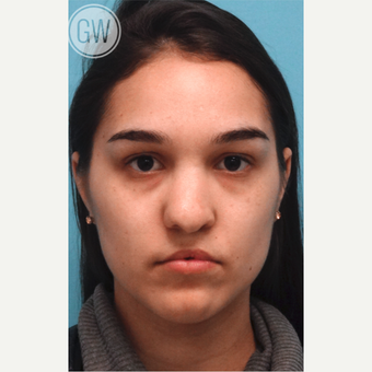 18-24 year old woman treated with Revision Rhinoplasty - Cleft nose with upper lip fat grafting before 3473490