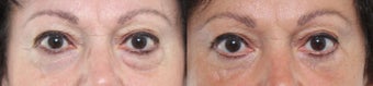 55-64 year old woman treated with Eyelid Surgery 3221411