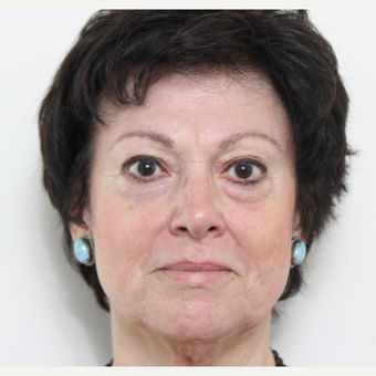 55-64 year old woman treated with Eyelid Surgery before 3221411