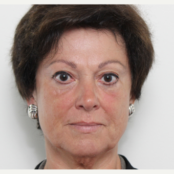 55-64 year old woman treated with Eyelid Surgery after 3221411