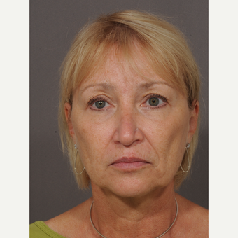 60 year old woman treated with Forehead Lift before 3324971