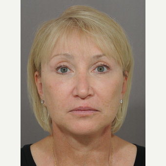 60 year old woman treated with Forehead Lift after 3324971