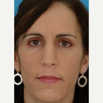 45-54 year old woman treated with Revision Rhinoplasty before 1847718