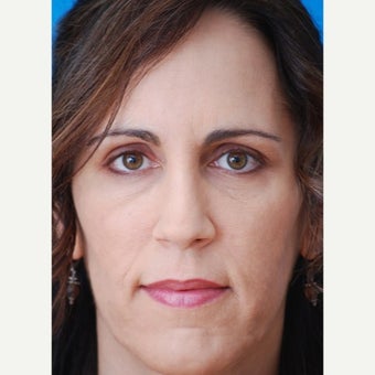 45-54 year old woman treated with Revision Rhinoplasty after 1847718