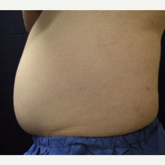 18-24 year old man treated with CoolSculpting before 3680184