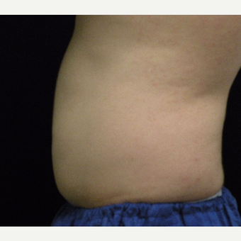 18-24 year old man treated with CoolSculpting after 3680184