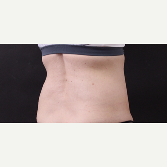 49 year old woman treated with CoolSculpting before 3630251