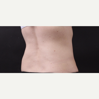 49 year old woman treated with CoolSculpting after 3630251