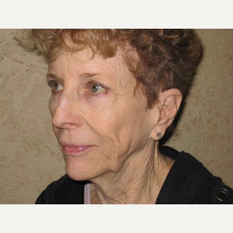 Facelift before 3454829