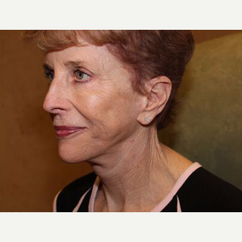 Facelift after 3454829