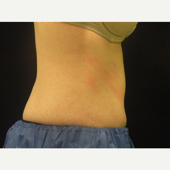 25-34 year old woman treated with CoolSculpting after 3680245