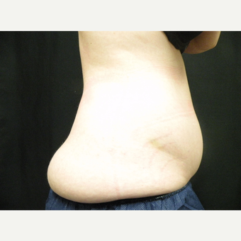 25-34 year old woman treated with CoolSculpting before 3680245