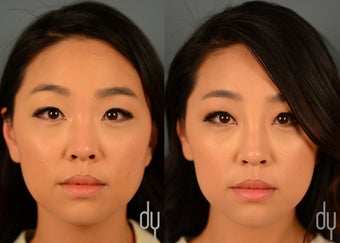 Nonsurgical Rhinoplasty | Nose Job with Restylane and Botox for masseter reduction before 1380252