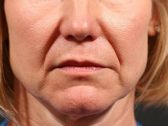 Juvederm Ultra XC to nasolabial folds before 1134749