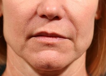 Juvederm Ultra XC to nasolabial folds after 1134749