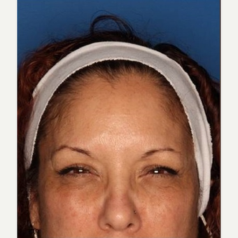45-54 year old woman treated with Botox after 3715445
