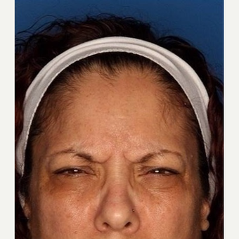45-54 year old woman treated with Botox before 3715445