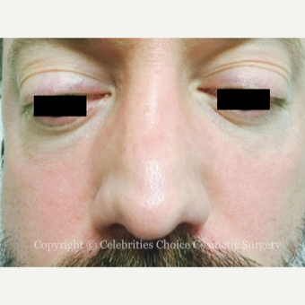 35-44 year old man treated with Revision Rhinoplasty before 3198206