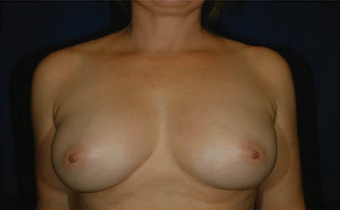 Natural Breast Augmentation with a Patients Own Fat after 1085562