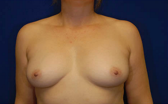 Natural Breast Augmentation with a Patients Own Fat before 1085562