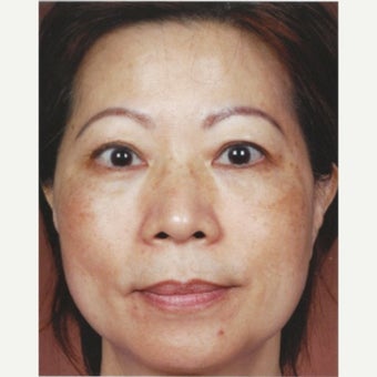 45-54 year old woman treated with Melasma Treatment with Obagi Nu Derm Skin Transformation System before 2581695