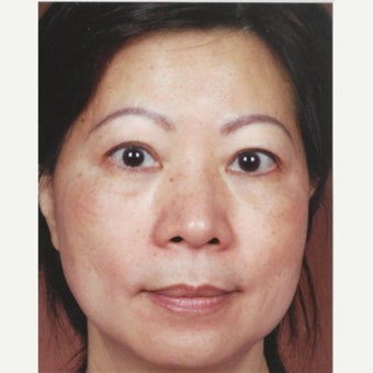45-54 year old woman treated with Melasma Treatment with Obagi Nu Derm Skin Transformation System after 2581695