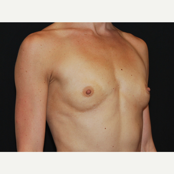 25-34 year old woman treated with Breast Implants before 3651613