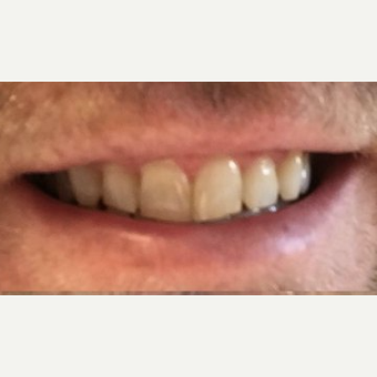 35-44 year old man treated with Zoom Whitening before 3258646