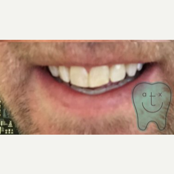 35-44 year old man treated with Zoom Whitening after 3258646
