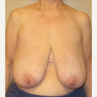 64 year old woman treated with Breast Reduction before 1544372