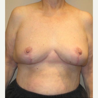 64 year old woman treated with Breast Reduction after 1544372