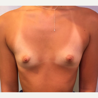 18-24 year old woman treated with Breast Augmentation before 3783473